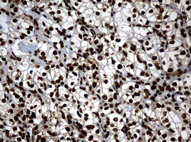 PCNA Antibody - IHC of paraffin-embedded Carcinoma of Human kidney tissue using anti-PCNA mouse monoclonal antibody. (Heat-induced epitope retrieval by 10mM citric buffer, pH6.0, 120°C for 3min).