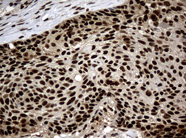 PCNA Antibody - IHC of paraffin-embedded Carcinoma of Human lung tissue using anti-PCNA mouse monoclonal antibody. (Heat-induced epitope retrieval by 10mM citric buffer, pH6.0, 120°C for 3min).