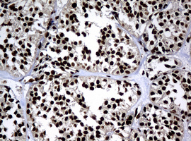 PCNA Antibody - IHC of paraffin-embedded Carcinoma of Human pancreas tissue using anti-PCNA mouse monoclonal antibody. (Heat-induced epitope retrieval by 10mM citric buffer, pH6.0, 120°C for 3min).