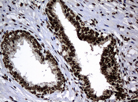 PCNA Antibody - IHC of paraffin-embedded Carcinoma of Human prostate tissue using anti-PCNA mouse monoclonal antibody. (Heat-induced epitope retrieval by 10mM citric buffer, pH6.0, 120°C for 3min).