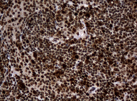 PCNA Antibody - IHC of paraffin-embedded Human lymphoma tissue using anti-PCNA mouse monoclonal antibody. (Heat-induced epitope retrieval by 10mM citric buffer, pH6.0, 120°C for 3min).