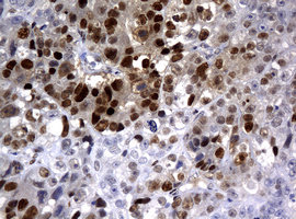 PCNA Antibody - IHC of paraffin-embedded Adenocarcinoma of Human colon tissue using anti-PCNA mouse monoclonal antibody.