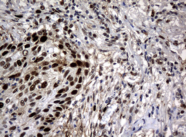 PCNA Antibody - IHC of paraffin-embedded Carcinoma of Human lung tissue using anti-PCNA mouse monoclonal antibody.