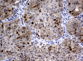 PCNA Antibody - IHC of paraffin-embedded Adenocarcinoma of Human ovary tissue using anti-PCNA mouse monoclonal antibody.