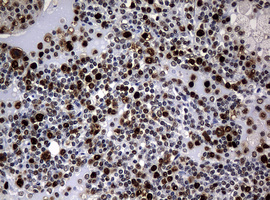 PCNA Antibody - IHC of paraffin-embedded Human lymphoma tissue using anti-PCNA mouse monoclonal antibody.