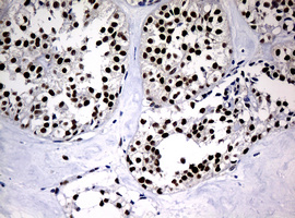 PCNA Antibody - IHC of paraffin-embedded Carcinoma of Human pancreas tissue using anti-PCNA mouse monoclonal antibody.