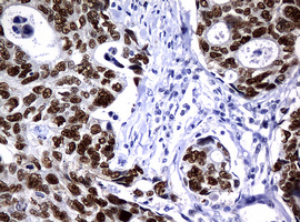 PCNA Antibody - IHC of paraffin-embedded Adenocarcinoma of Human breast tissue using anti-PCNA mouse monoclonal antibody.