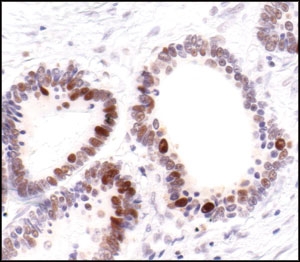 PCNA Antibody - Immunohistochemical analysis of paraffin-embedded human colon carcinoma, showing nuclear localization, using PCNA (PC10) Mouse mAb.  This image was taken for the unconjugated form of this product. Other forms have not been tested.