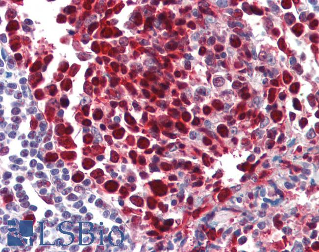 PCNA Antibody - Anti-PCNA antibody IHC of human tonsil. Immunohistochemistry of formalin-fixed, paraffin-embedded tissue after heat-induced antigen retrieval. Antibody concentration 10 ug/ml.  This image was taken for the unconjugated form of this product. Other forms have not been tested.
