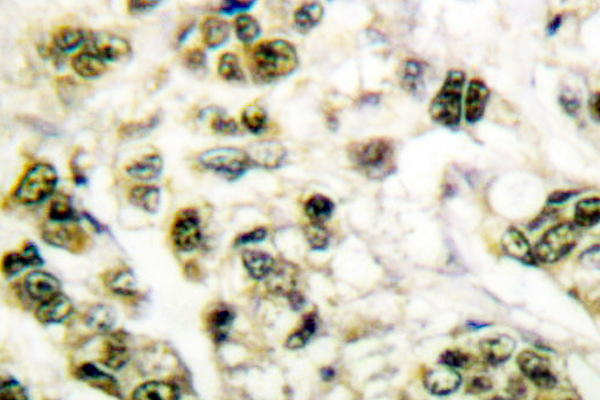 PCNA Antibody - IHC of PCNA (I88) pAb in paraffin-embedded human breast carcinoma tissue.