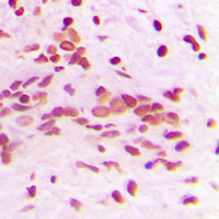 PCNA Antibody - Immunohistochemical analysis of PCNA staining in human breast cancer formalin fixed paraffin embedded tissue section. The section was pre-treated using heat mediated antigen retrieval with sodium citrate buffer (pH 6.0). The section was then incubated with the antibody at room temperature and detected using an HRP conjugated compact polymer system. DAB was used as the chromogen. The section was then counterstained with hematoxylin and mounted with DPX.