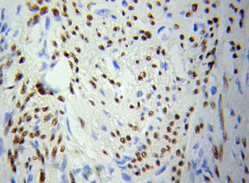 PCNA Antibody - Immunohistochemistry (IHC) analysis of PCNA pAb in paraffin-embedded Breast cancer tissue.