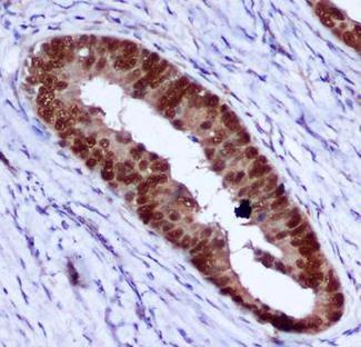 PCNA Antibody - Immunohistochemical analysis of paraffin-embedded human colorectal carcinoma with PCNA mouse monoclonal antibody (2E1-G10-H10, 1:400 diluted), showing nuclear localization.A high pressure mediated antigen retrieval step was performed in citrate buffer(pH 6.0).