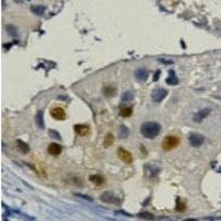 PCNA Antibody - Immunohistochemical analysis of PCNA staining in human breast cancer formalin fixed paraffin embedded tissue section. The section was pre-treated using heat mediated antigen retrieval with sodium citrate buffer (pH 6.0). The section was then incubated with the antibody at room temperature and detected using an HRP conjugated compact polymer system. DAB was used as the chromogen. The section was then counterstained with hematoxylin and mounted with DPX.