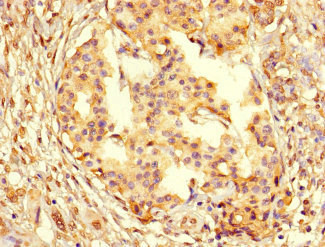 PCNA Antibody - Immunohistochemistry of paraffin-embedded human pancreatic cancer at dilution 1:100