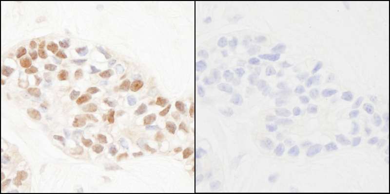 PCNA Antibody - Detection of Human Phospho-PCNA (Y211) by Immunohistochemistry. Samples: FFPE serial sections of human breast carcinoma. Mock phosphatase treated section (left) or calf intestinal phosphatase-treated section (right) immunostained for Phospho-PCNA (Y211). Antibody: Affinity purified rabbit anti-Phospho-PCNA (Y211) used at a dilution of 1:250 and incubated for 18 hours at room temperature.