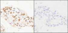 PCNA Antibody - Detection of Human Phospho-PCNA (Y211) by Immunohistochemistry. Samples: FFPE serial sections of human breast carcinoma. Mock phosphatase treated section (left) or calf intestinal phosphatase-treated section (right) immunostained for Phospho-PCNA (Y211). Antibody: Affinity purified rabbit anti-Phospho-PCNA (Y211) used at a dilution of 1:250 and incubated for 18 hours at room temperature.
