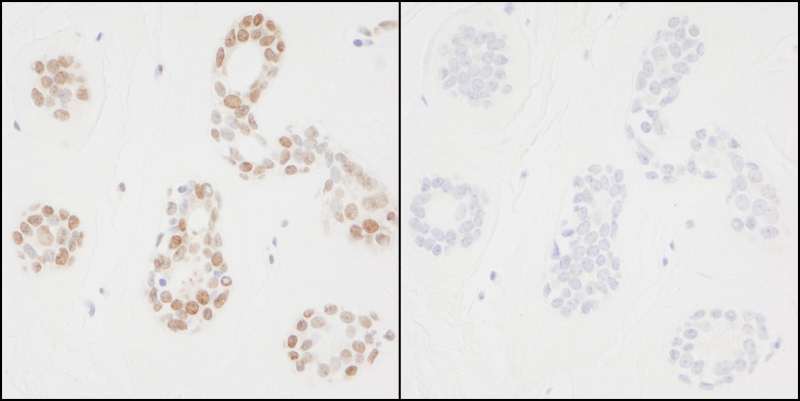 PCNA Antibody - Detection of Human Phospho-PCNA (Y211) by Immunohistochemistry. Samples: FFPE serial sections of human breast tissue. Mock phosphatase treated section (left) or calf intestinal phosphatase-treated section (right) immunostained for Phospho-PCNA (Y211). Antibody: Affinity purified rabbit anti-Phospho-PCNA (Y211) used at a dilution of 1:250 and incubated for 18 hours at room temperature.