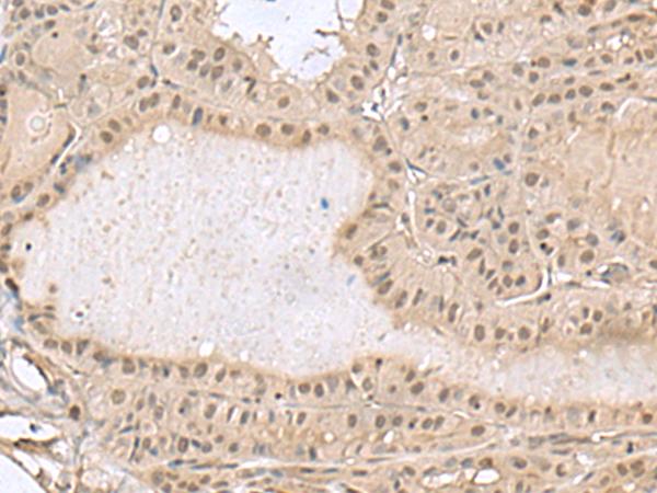 PCNA-Associated Factor Antibody - Immunohistochemistry of paraffin-embedded Human thyroid cancer tissue  using PCLAF Polyclonal Antibody at dilution of 1:50(×200)