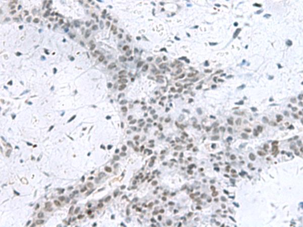 PCNA-Associated Factor Antibody - Immunohistochemistry of paraffin-embedded Human breast cancer tissue  using PCLAF Polyclonal Antibody at dilution of 1:80(×200)