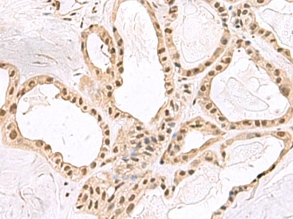 PCNA-Associated Factor Antibody - Immunohistochemistry of paraffin-embedded Human thyroid cancer tissue  using PCLAF Polyclonal Antibody at dilution of 1:60(×200)