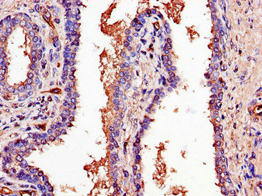 PCOTH Antibody - Immunohistochemistry of paraffin-embedded human prostate cancer using C1QTNF9B-AS1 Antibody at dilution of 1:100