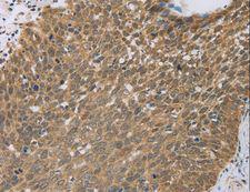 PCP4 / PEP19 Antibody - Immunohistochemistry of paraffin-embedded Human cervical cancer using PCP4 Polyclonal Antibody at dilution of 1:50.