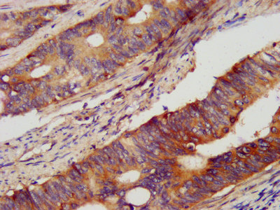 PCSK2 Antibody - Immunohistochemistry image at a dilution of 1:400 and staining in paraffin-embedded human colon cancer performed on a Leica BondTM system. After dewaxing and hydration, antigen retrieval was mediated by high pressure in a citrate buffer (pH 6.0) . Section was blocked with 10% normal goat serum 30min at RT. Then primary antibody (1% BSA) was incubated at 4 °C overnight. The primary is detected by a biotinylated secondary antibody and visualized using an HRP conjugated SP system.