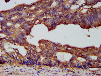 PCSK7 / PC7 Antibody - Immunohistochemistry image at a dilution of 1:200 and staining in paraffin-embedded human colon cancer performed on a Leica BondTM system. After dewaxing and hydration, antigen retrieval was mediated by high pressure in a citrate buffer (pH 6.0) . Section was blocked with 10% normal goat serum 30min at RT. Then primary antibody (1% BSA) was incubated at 4 °C overnight. The primary is detected by a biotinylated secondary antibody and visualized using an HRP conjugated SP system.