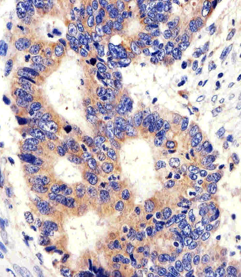 PCSK9 Antibody - Immunohistochemical of paraffin-embedded H.colon carcinoma section using PCSK9 Antibody. Antibody was diluted at 1:100 dilution. A peroxidase-conjugated goat anti-rabbit IgG at 1:400 dilution was used as the secondary antibody, followed by DAB staining.