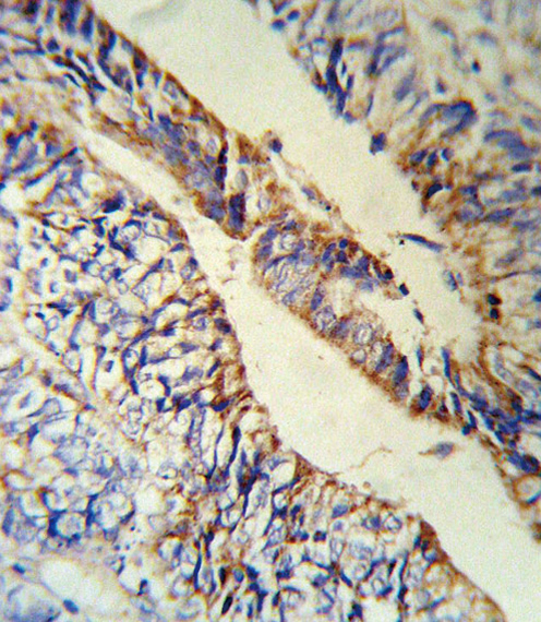 PCSK9 Antibody - PCSK9 Antibody (RB18880) IHC of formalin-fixed and paraffin-embedded human Colon carcinoma followed by peroxidase-conjugated secondary antibody and DAB staining.
