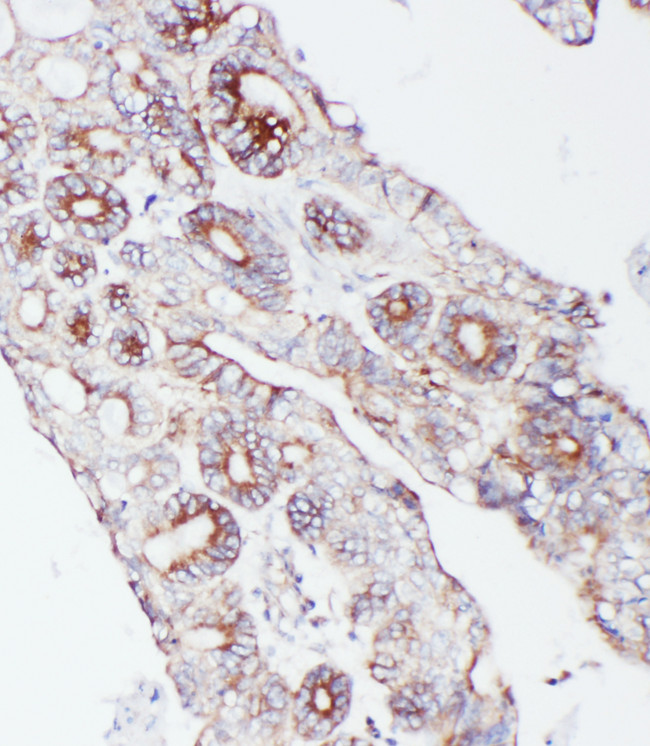 PCSK9 Antibody - PCSK9 antibody. IHC(P): Human Intestinal Cancer Tissue.