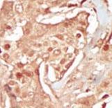 PCTK3 / CDK18 Antibody - Formalin-fixed and paraffin-embedded human cancer tissue reacted with the primary antibody, which was peroxidase-conjugated to the secondary antibody, followed by DAB staining. This data demonstrates the use of this antibody for immunohistochemistry; clinical relevance has not been evaluated. BC = breast carcinoma; HC = hepatocarcinoma.