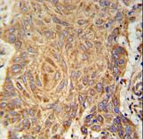 PCYOX1L Antibody - PCYXL Antibody immunohistochemistry of formalin-fixed and paraffin-embedded human Lung carcinoma followed by peroxidase-conjugated secondary antibody and DAB staining.