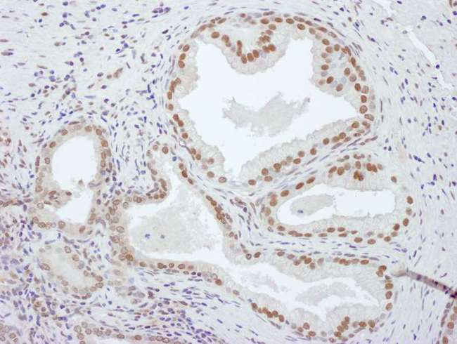PCYT1A / CCT Alpha Antibody - Detection of human PCYT1A by immunohistochemistry. Sample: FFPE section of human prostate carcinoma. Antibody: Affinity purified rabbit anti- PCYT1A used at a dilution of 1:1,000 (1µg/ml). Detection: DAB. Counterstain: IHC Hematoxylin (blue).