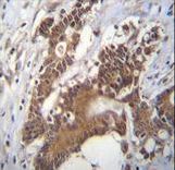PCYT1A / CCT Alpha Antibody - PCYT1A Antibody immunohistochemistry of formalin-fixed and paraffin-embedded human colon carcinoma followed by peroxidase-conjugated secondary antibody and DAB staining.