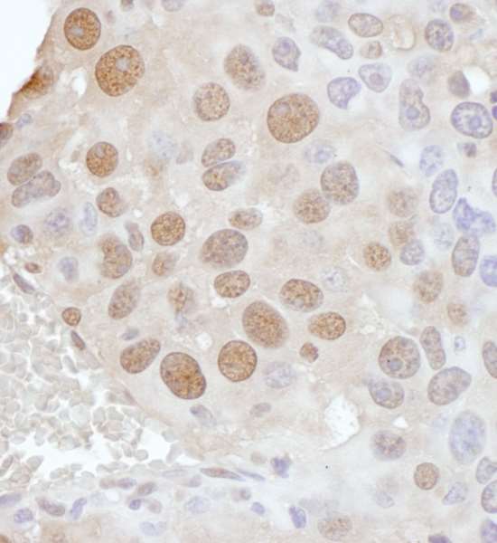 PCYT1A / CCT Alpha Antibody - Detection of mouse PCYT1A by immunohistochemistry. Sample: FFPE section of mouse renal cell carcinoma. Antibody: Affinity purified rabbit anti- PCYT1A used at a dilution of 1:1,000 (1µg/ml). Detection: DAB