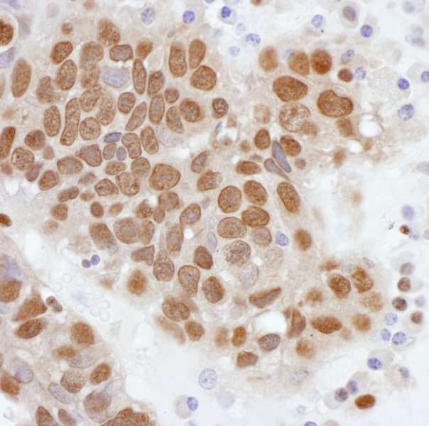 PCYT1A / CCT Alpha Antibody - Detection of human PCYT1A by immunohistochemistry. Sample: FFPE section of human ovarian carcinoma. Antibody: Affinity purified rabbit anti- PCYT1A used at a dilution of 1:1,000 (1µg/ml). Detection: DAB