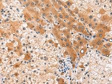 PCYT2 / ET Antibody - Immunohistochemistry of paraffin-embedded Human liver cancer tissue  using PCYT2 Polyclonal Antibody at dilution of 1:85(×200)