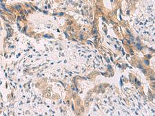 PCYT2 / ET Antibody - Immunohistochemistry of paraffin-embedded Human cervical cancer tissue  using PCYT2 Polyclonal Antibody at dilution of 1:55(×200)