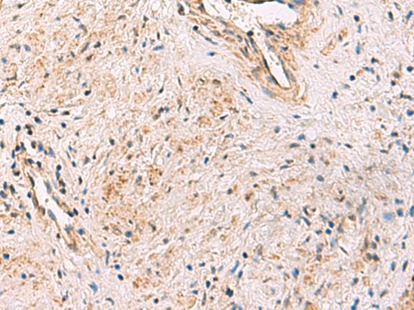 PCYT2 / ET Antibody - Immunohistochemistry of paraffin-embedded Human prost ate cancer tissue  using PCYT2 Polyclonal Antibody at dilution of 1:55(×200)
