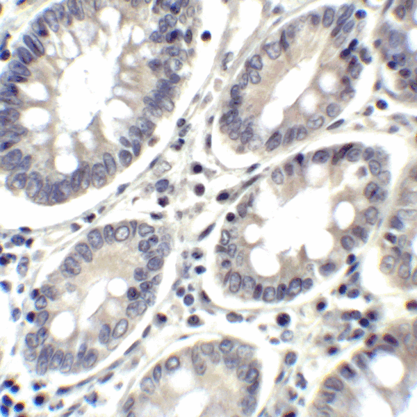 PD-L2 / PDCD1LG2 / CD273 Antibody - Immunohistochemistry of PD-L2 in human colon carcinoma tissue with PD-L2 antibody at 2 ug/mL.