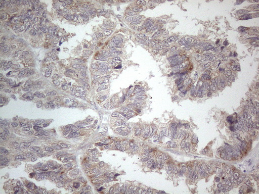 PD-L2 / PDCD1LG2 / CD273 Antibody - Immunohistochemical staining of paraffin-embedded Adenocarcinoma of Human ovary tissue using anti-PDCD1LG2 mouse monoclonal antibody. (Heat-induced epitope retrieval by 1mM EDTA in 10mM Tris buffer. (pH8.5) at 120°C for 3 min. (1:150) .