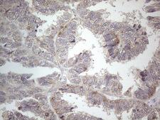 PD-L2 / PDCD1LG2 / CD273 Antibody - Immunohistochemical staining of paraffin-embedded Adenocarcinoma of Human ovary tissue using anti-PDCD1LG2 mouse monoclonal antibody. (Heat-induced epitope retrieval by 1mM EDTA in 10mM Tris buffer. (pH8.5) at 120°C for 3 min. (1:150) .