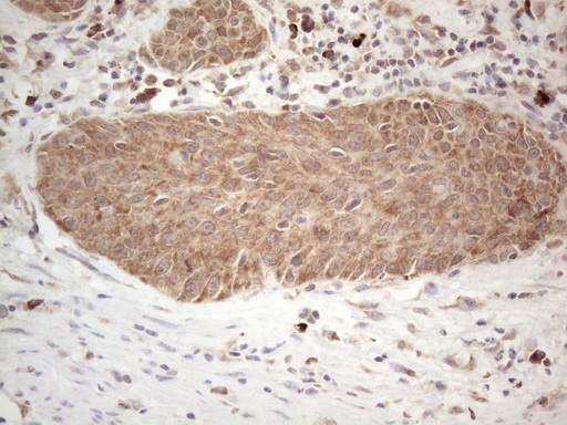 PD-L2 / PDCD1LG2 / CD273 Antibody - Immunohistochemical staining of paraffin-embedded Carcinoma of Human bladder tissue using anti-PDCD1LG2 mouse monoclonal antibody. (Heat-induced epitope retrieval by 1mM EDTA in 10mM Tris buffer. (pH8.5) at 120°C for 3 min. (1:150) Dilution: 1:150