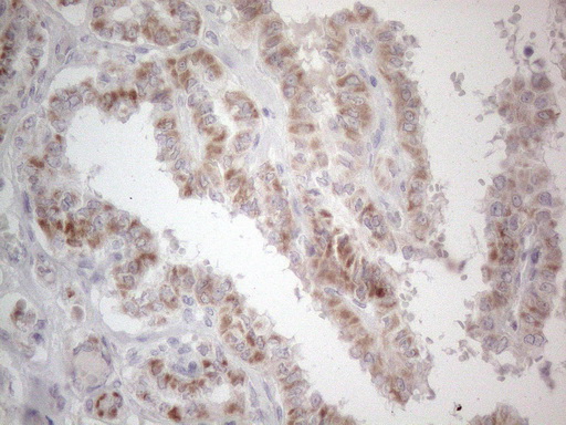PD-L2 / PDCD1LG2 / CD273 Antibody - Immunohistochemical staining of paraffin-embedded Carcinoma of Human thyroid tissue using anti-PDCD1LG2 mouse monoclonal antibody. (Heat-induced epitope retrieval by 1mM EDTA in 10mM Tris buffer. (pH8.5) at 120°C for 3 min. (1:150)