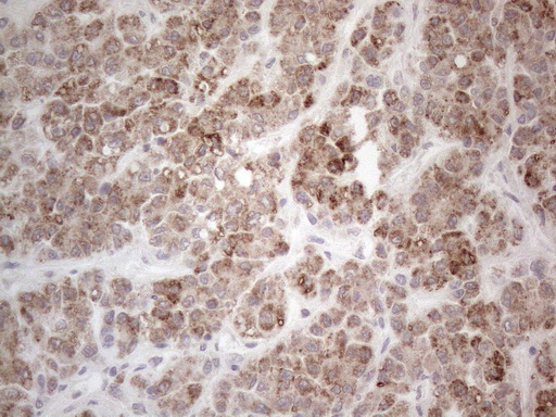 PD-L2 / PDCD1LG2 / CD273 Antibody - Immunohistochemical staining of paraffin-embedded Human liver tissue within the normal limits using anti-PDCD1LG2 mouse monoclonal antibody. (Heat-induced epitope retrieval by 1mM EDTA in 10mM Tris buffer. (pH8.5) at 120°C for 3 min. (1:150)