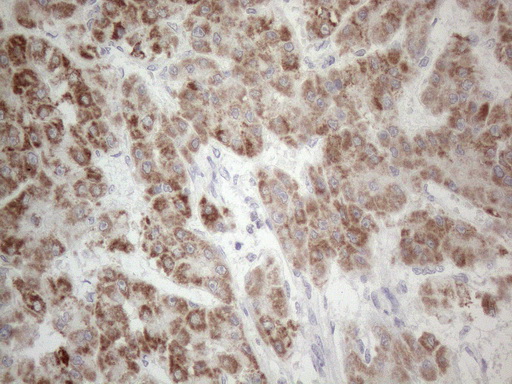 PD-L2 / PDCD1LG2 / CD273 Antibody - Immunohistochemical staining of paraffin-embedded Carcinoma of Human liver tissue using anti-PDCD1LG2 mouse monoclonal antibody. (Heat-induced epitope retrieval by 1mM EDTA in 10mM Tris buffer. (pH8.5) at 120°C for 3 min. (1:150)