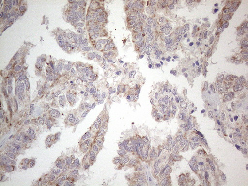 PD-L2 / PDCD1LG2 / CD273 Antibody - Immunohistochemical staining of paraffin-embedded Adenocarcinoma of Human ovary tissue using anti-PDCD1LG2 mouse monoclonal antibody. (Heat-induced epitope retrieval by 1mM EDTA in 10mM Tris buffer. (pH8.5) at 120°C for 3 min. (1:150).