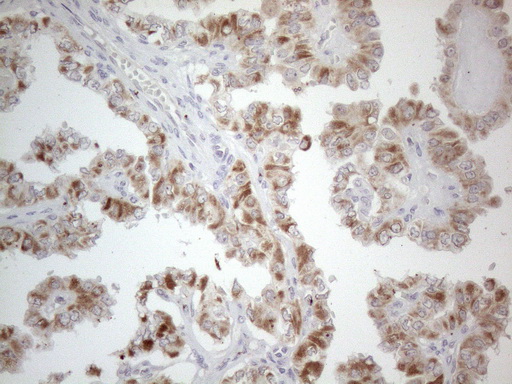 PD-L2 / PDCD1LG2 / CD273 Antibody - Immunohistochemical staining of paraffin-embedded Carcinoma of Human thyroid tissue using anti-PDCD1LG2 mouse monoclonal antibody. (Heat-induced epitope retrieval by 1mM EDTA in 10mM Tris buffer. (pH8.5) at 120°C for 3 min. (1:150) Dilution: 1:150